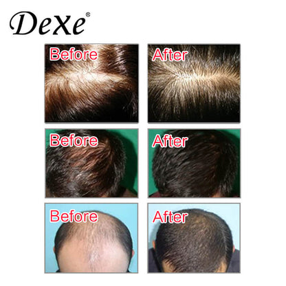 Dexe Anti Hair Loss Shampoo 200 ml Strengthens Hair & Reduces Hair Fall